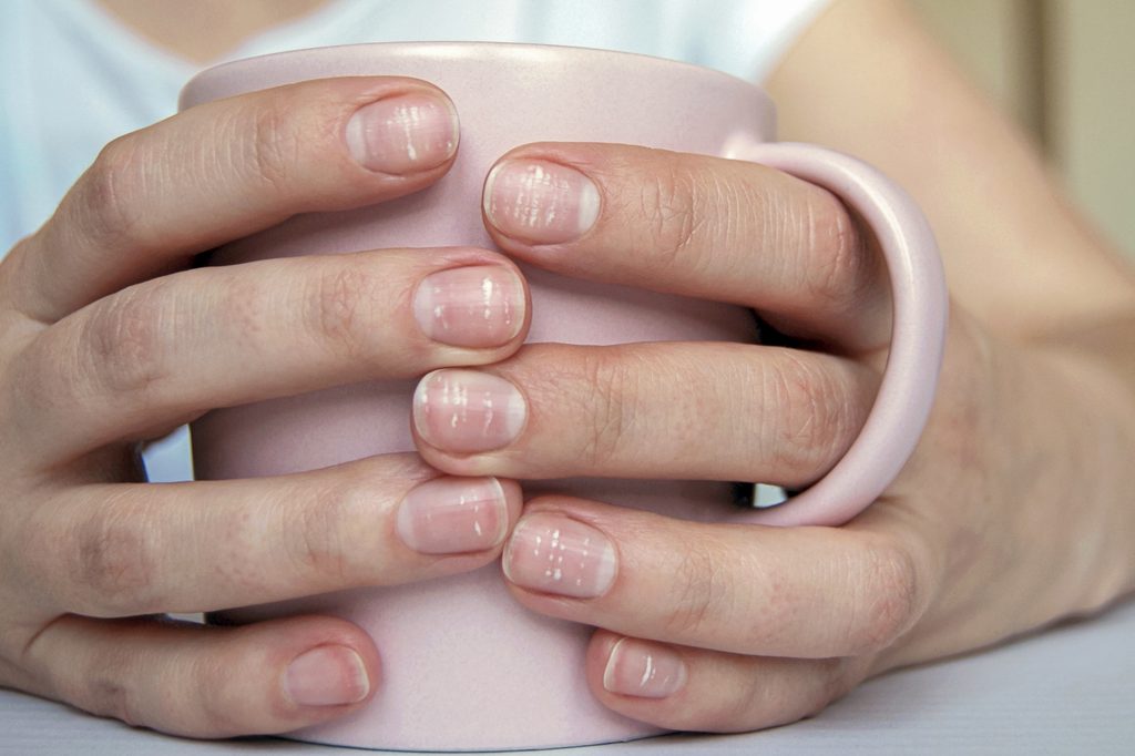 Many white spots on fingernails (Leukonychia) due to calcium deficiency or stress. Female hands holding mug
